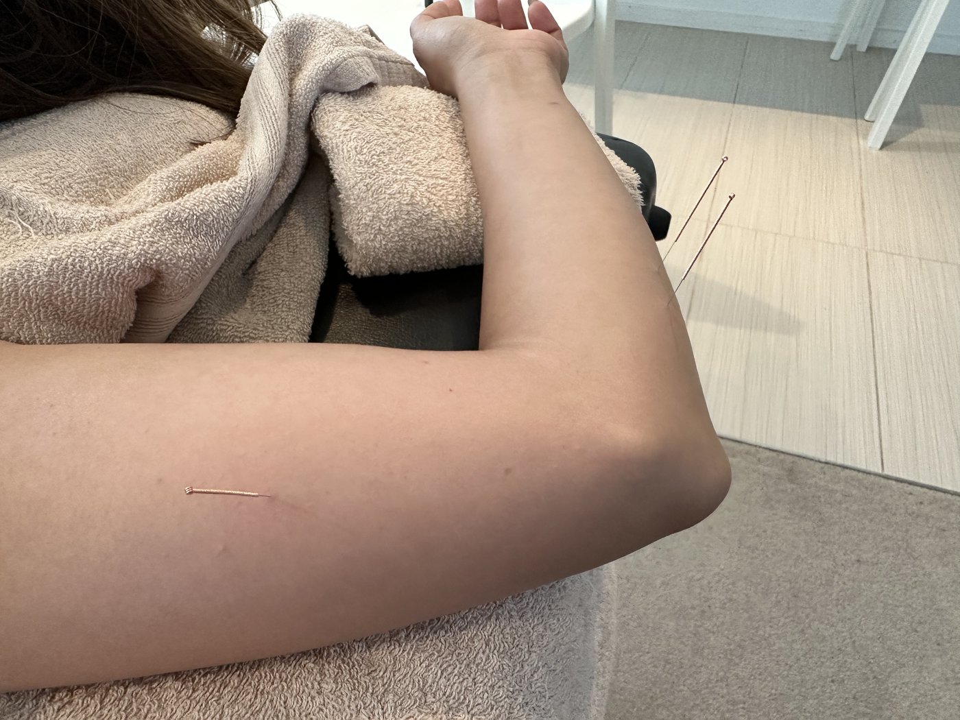 Fine dry-needling needles placed in the forearm during treatment